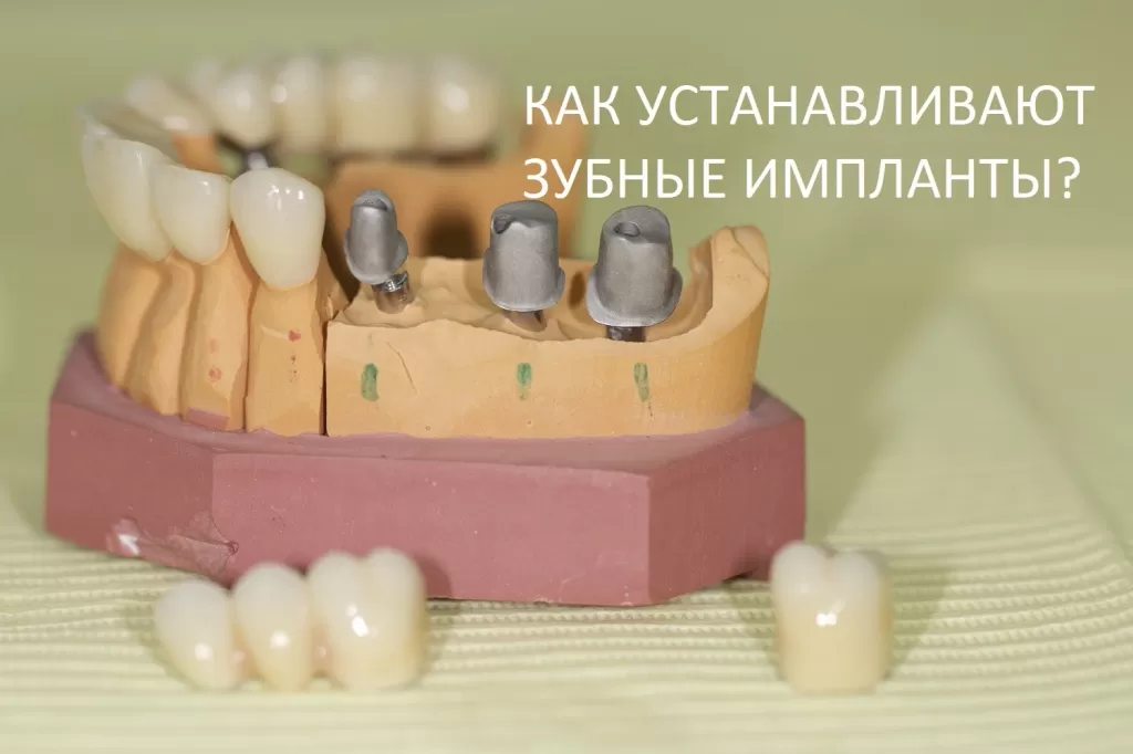Как устанавливают зубные импланты